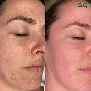 Bio- microneedling
